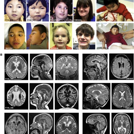 Kids with TBCD with MRIs